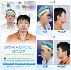 CHỈNH HÀM MÓM NỘI SOI – KHI MỘT ĐIỂM NHỎ TRÊN HÀM CŨNG THAY ĐỔI NỤ CƯỜI VÀ SỰ TỰ TIN