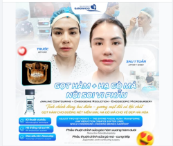 GỌT HÀM + HẠ GÒ MÁ NỘI SOI VI PHẪU – KHI CHỈNH SỬA HAI ĐIỂM NHỎ, CẢ GƯƠNG MẶT ĐỔI KHÍ CHẤT