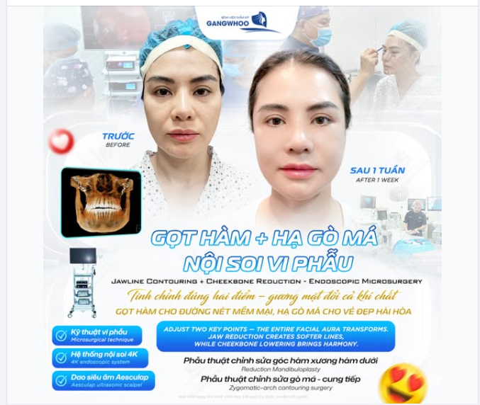 GỌT HÀM + HẠ GÒ MÁ NỘI SOI VI PHẪU – KHI CHỈNH SỬA HAI ĐIỂM NHỎ, CẢ GƯƠNG MẶT ĐỔI KHÍ CHẤT