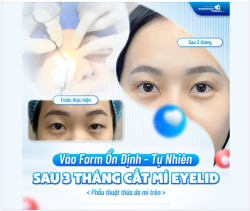 CẮT MÍ EYELID, MÍ ĐẸP VÀ TỰ NHIÊN