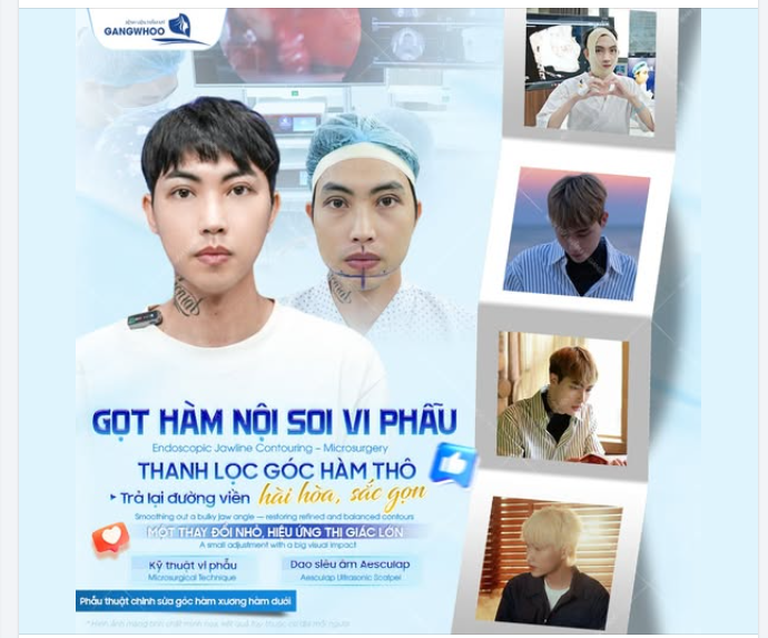 GỌT HÀM NỘI SOI VI PHẪU – KHI MỘT CHỈNH SỬA NHỎ MANG LẠI HIỆU ỨNG THỊ GIÁC LỚN