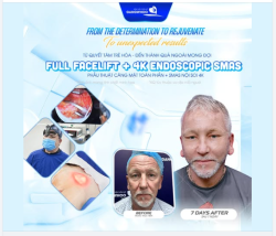 ​​​​​​​Phẫu thuật căng da mặt toàn phần + SMAS nội soi 4K không chỉ là giải pháp cải thiện diện mạo, mà là sự đầu tư đúng đắn cho phong thái – sự tự tin – và chất lượng cuộc sống.