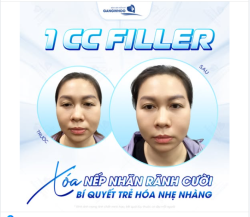 1 CC FILLER XÓA NẾP NHĂN RÃNH CƯỜI  Bí quyết trẻ hóa nhẹ nhàng