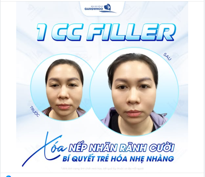 1 CC FILLER XÓA NẾP NHĂN RÃNH CƯỜI  Bí quyết trẻ hóa nhẹ nhàng