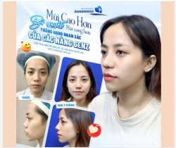 MŨI CAO HƠN - MẶT SANG HƠN