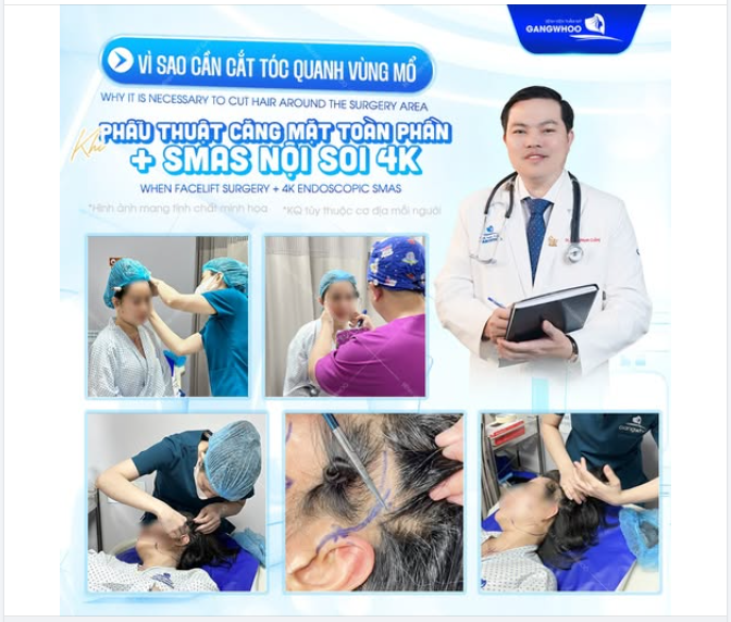 ​​​​​​​ CẮT TÓC QUANH VÙNG MỔ Là một bước nhỏ — nhưng đóng vai trò rất quan trọng trong thành công của phẫu thuật căng da mặt toàn phần + SMAS nội soi 4K.