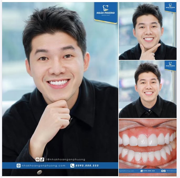 Tái khám răng sứ sau hơn 2 năm cho anh Ngọc Hoàng