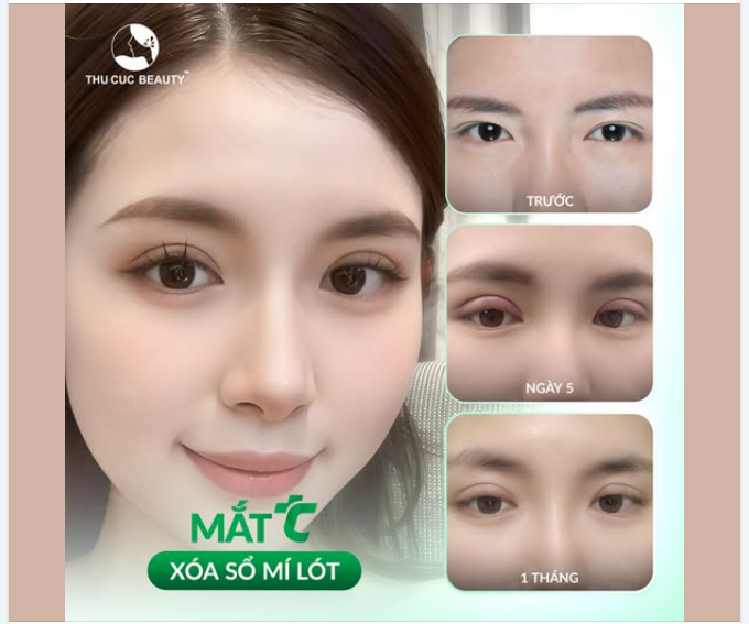 Mắt TC "Cứu tinh" của các cặp mí lót/một mí/đa mí/mí hỏng...