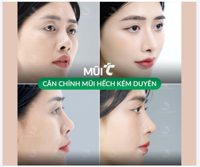 Mũi TC 13.5Tr Ưu đãi hot dành cho chị em mũi hếch, co rút