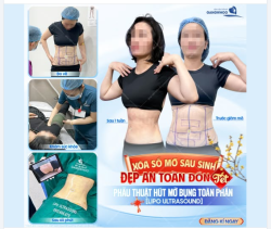 XÓA SỔ MỠ SAU SINH - ĐẸP AN TOÀN ĐÓN TẾT