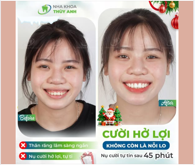 45 PHÚT “ĐÁNH BAY” HỞ LỢI – SỞ HỮU NỤ CƯỜI ĐẸP NGAY LẬP TỨC