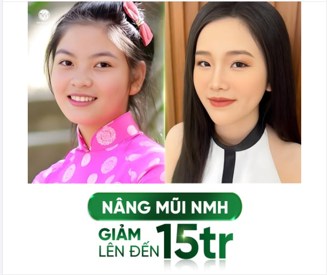 Hành trình dậy thì thành công.  Nâng mũi MNH - Giảm đến 50%