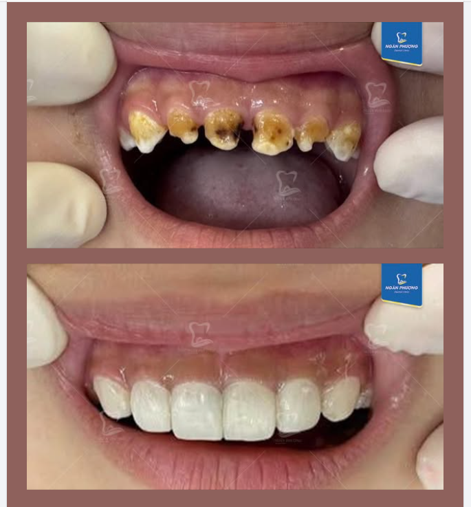 Răng sữa rồi cũng sẽ thay nhưng vẫn cần chăm sóc và bảo vệ ba mẹ nhé