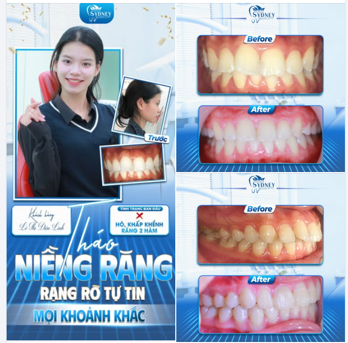THÁO NIỀNG RĂNG - RẠNG RỠ TỰ TIN MỌI KHOẢNH KHẮC