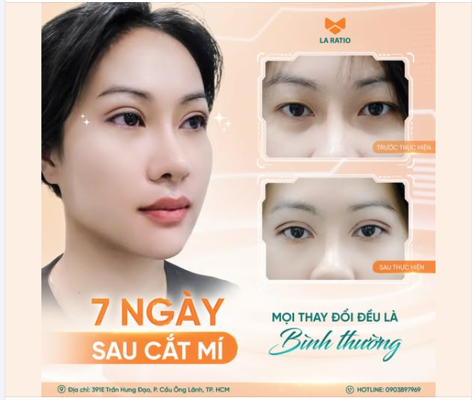 7 NGÀY SAU CẮT MÍ – MỖI THAY ĐỔI ĐỀU LÀ MỘT PHẦN CỦA HÀNH TRÌNH