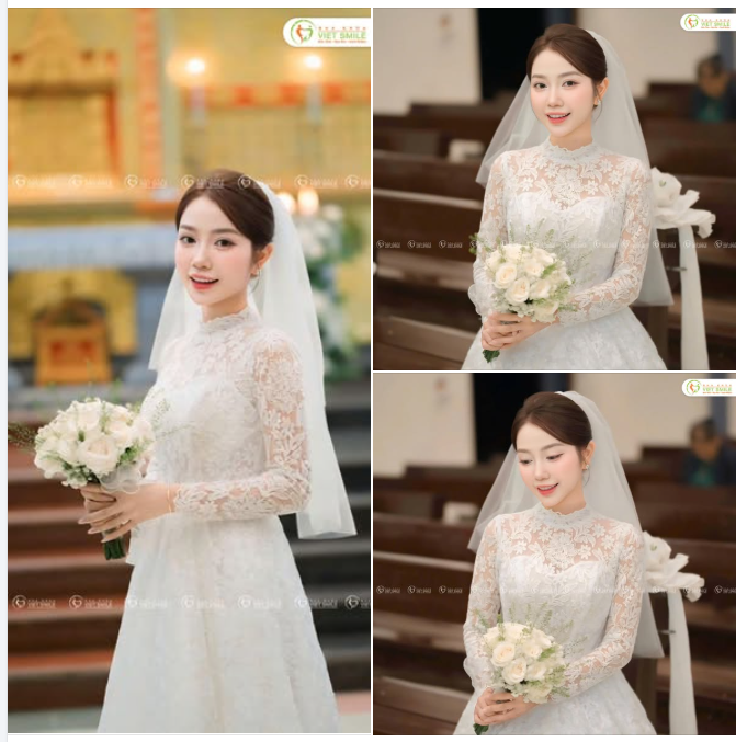 RĂNG SỨ TRẮNG XINH – RẠNG RỠ NGÀY CƯỚI