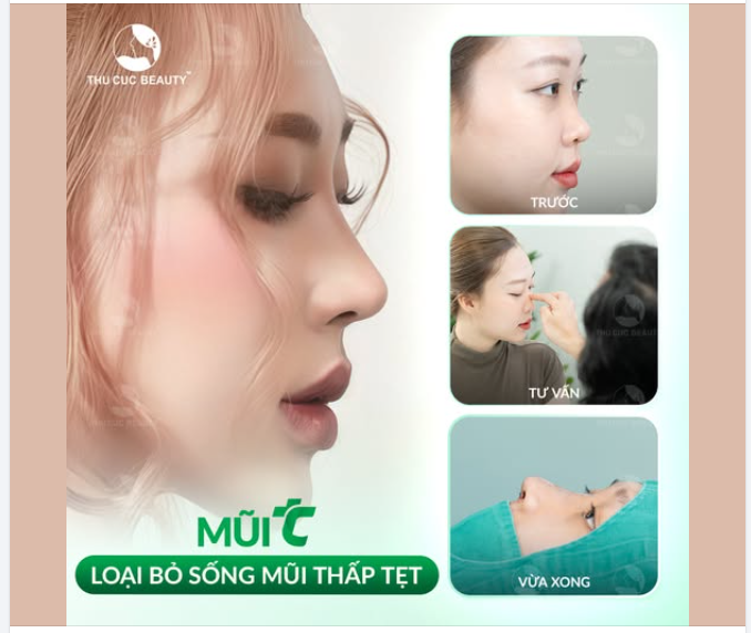 Thần thái sang - gương mặt bừng sáng sau khi nâng mũi tại Thu Cúc
