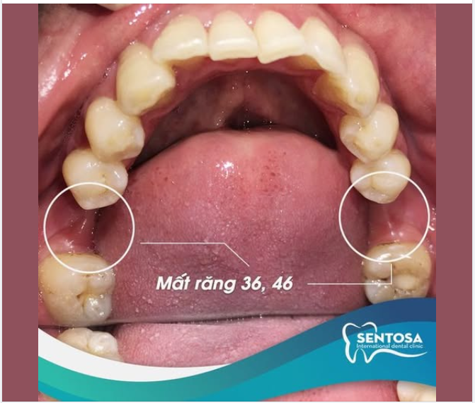 KHI HAI CHIẾC RĂNG HÀM MẤT ĐI, CHẤT LƯỢNG ĂN UỐNG MỚI THẤY QUAN TRỌNG THẾ NÀO