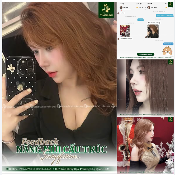 Feedback Nâng mũi sau 15 ngày tới 1 tháng đẹp ''chấn động''!!