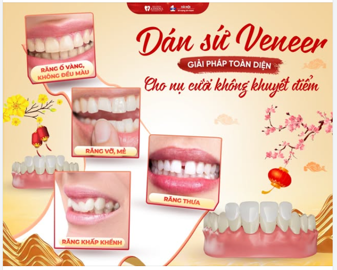 DÁN SỨ VENEER: GIẢI PHÁP TOÀN DIỆN CHO NỤ CƯỜI KHÔNG KHUYẾT ĐIỂM