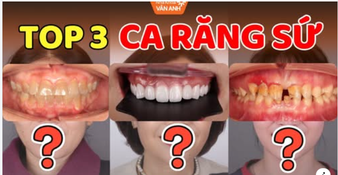 TOP 3 CA RĂNG SỨ THẨM MỸ ẤN TƯỢNG NHẤT NHA KHOA VÂN ANH