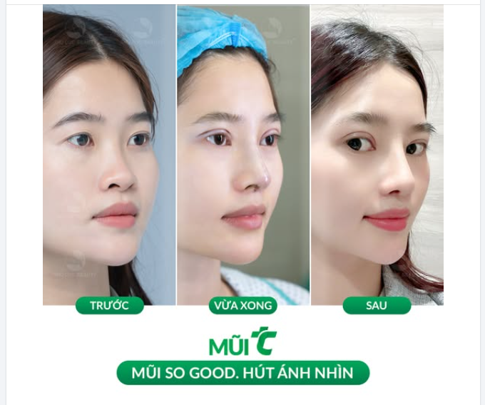 Mũi TC Khắc phục dáng mũi thiếu điểm nhấn sau 30 phút