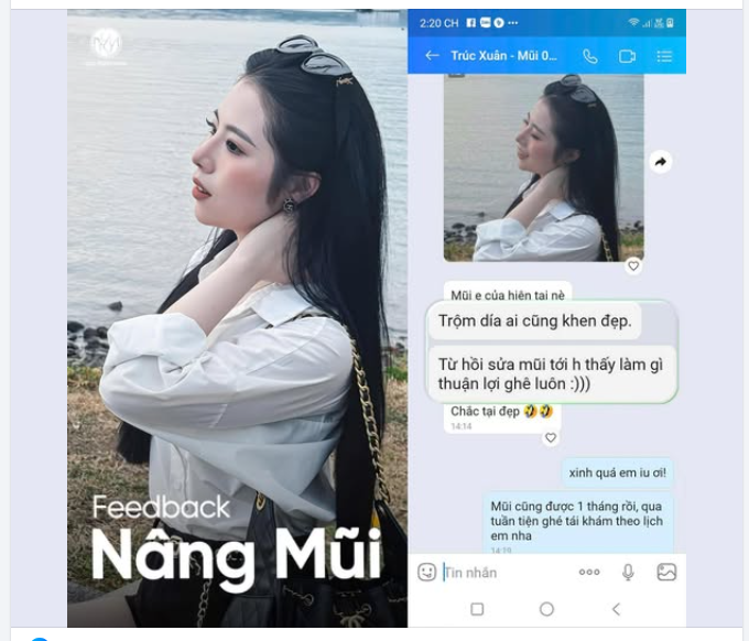 "Trộm día ai cũng khen đẹp" - KH Bệnh viện Ngô Mộng Hùng chia sẻ sau nâng mũi