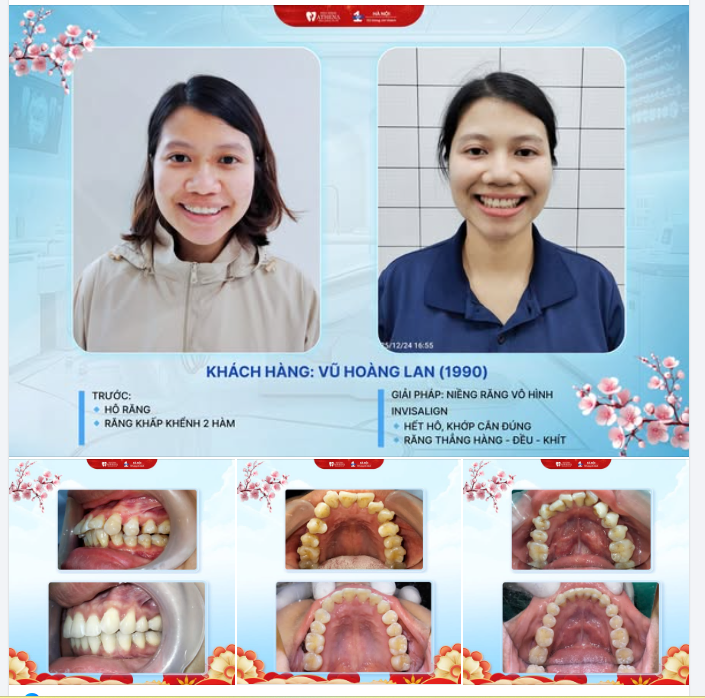 HƠN 30 TUỔI CÓ NIỀNG RĂNG ĐƯỢC KHÔNG