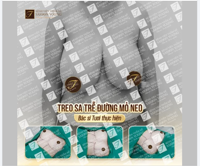 TREO SA TRỄ ĐƯỜNG MỎ NEO