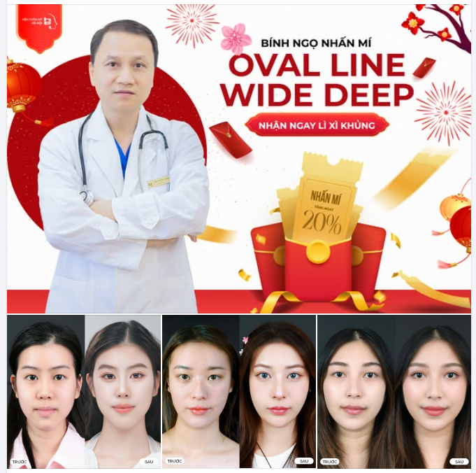 NHẤN MÍ OVAL LINE WIDE DEEP – ĐÓN TẾT BÍNH NGỌ 2026