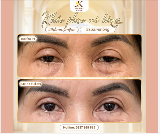 Mí “Phượng Hoàng” chưa chắc đẹp bằng mí tự nhiên 