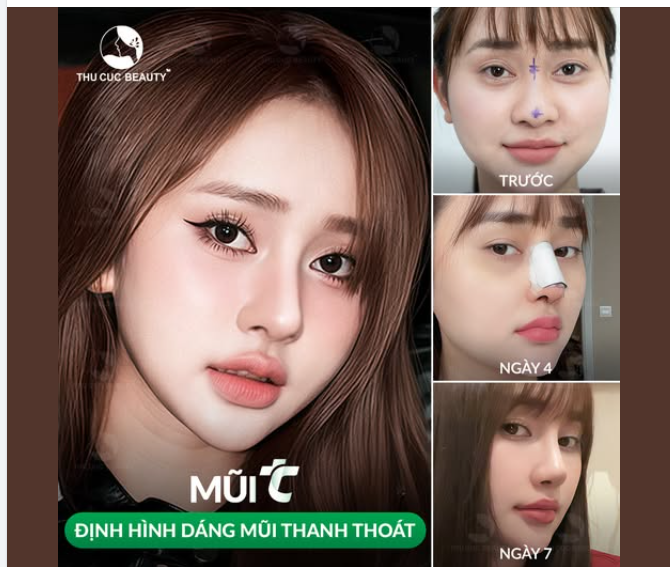 Mũi TC Nâng mũi vừa phải, hợp gương mặt
