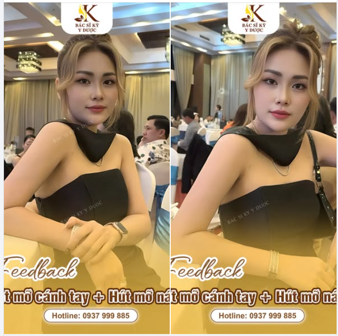 Giảm mỡ cánh tay tự tin diện đồ  Không để lại sẹo, nhẹ nhàng, đẹp nhanh!