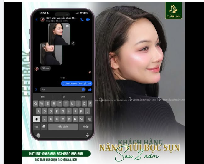 FEEDBACK NÂNG MŨI BỌC SỤN SAU 2 NĂM