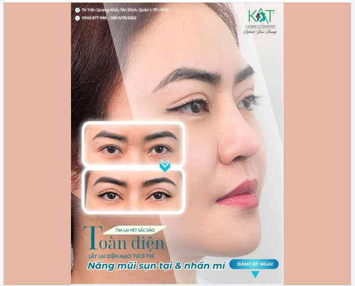 Nâng mũi sụn tai Nhấn mí – Combo “hack visual” cực đỉnh