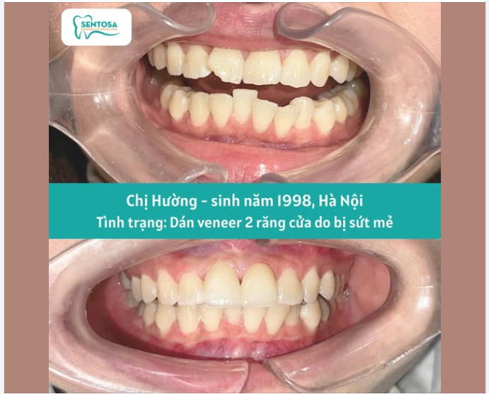 MỘT THAY ĐỔI NHỎ CHO NỤ CƯỜI TỰ NHIÊN HƠN MỖI NGÀY