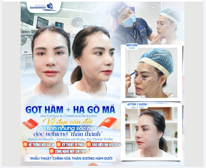 COMBO GỌT HÀM + HẠ GÒ MÁ: VẺ ĐẸP CÂN ĐỐI – NỮ TÍNH NHƯNG SẮC NÉT, GÓC NGHIÊNG “THẦN THÁNH”