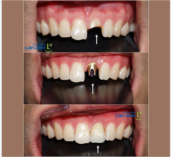 Răng bị gãy quá trời mà bác sĩ tại nha khoa Lan Anh vẫn phục hình lại đẹp như xưa luôn ạ