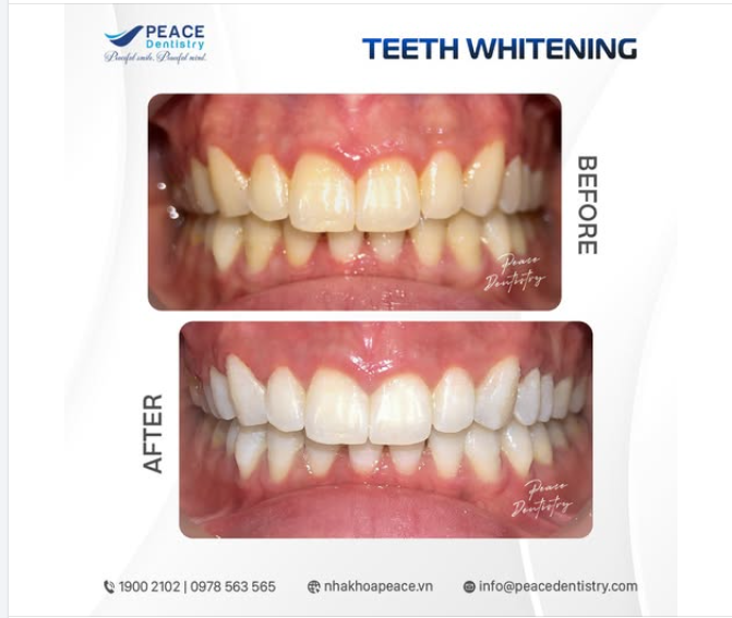 3 LỢI THẾ KHI TẨY TRẮNG TẠI PEACE DENTISTRY