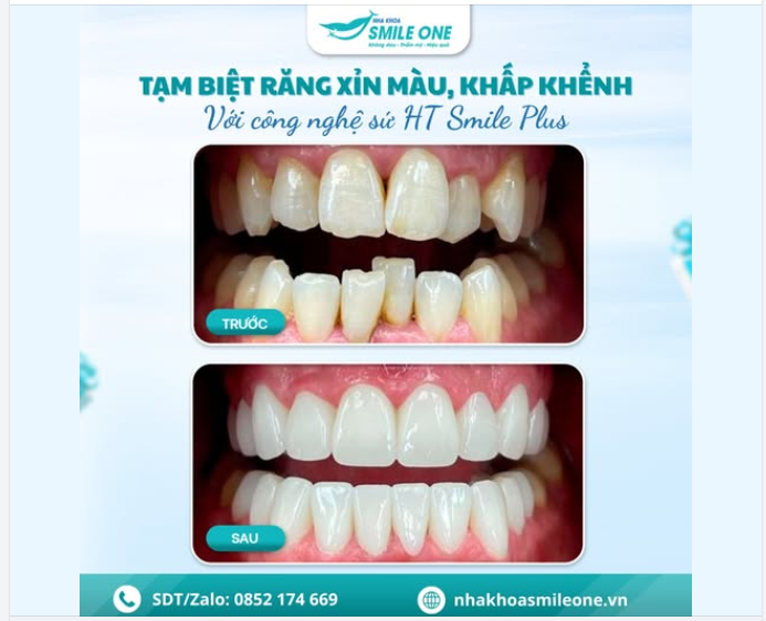 RĂNG XINH ĐÓN TẾT – TỰ TIN KHOE DIỆN MẠO MỚI!