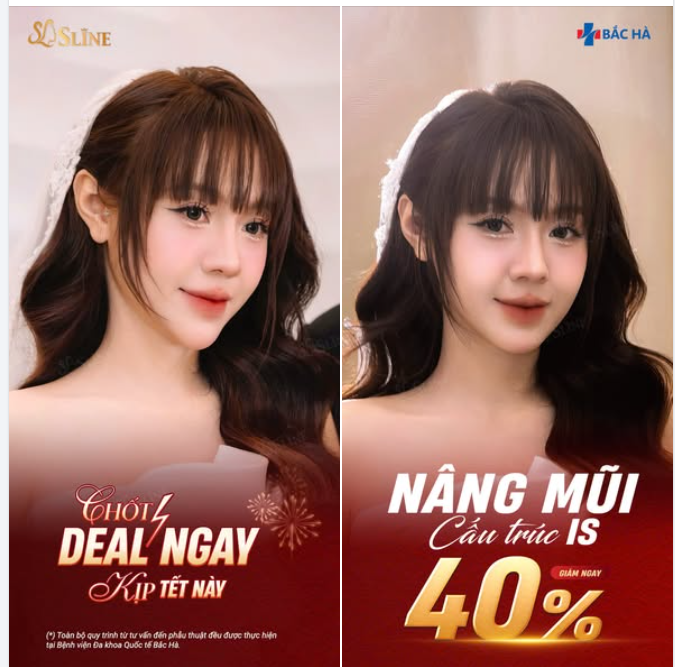 FEEDBACK THẬT – MŨI ĐẸP THẤY NGAY SAU THỰC HIỆN