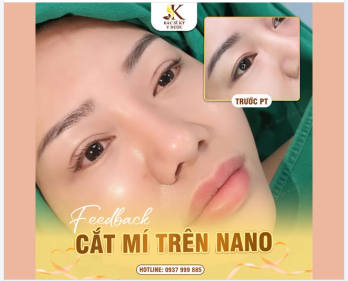 Nếp mí to đẹp rõ ràng hơn sau 2 tháng