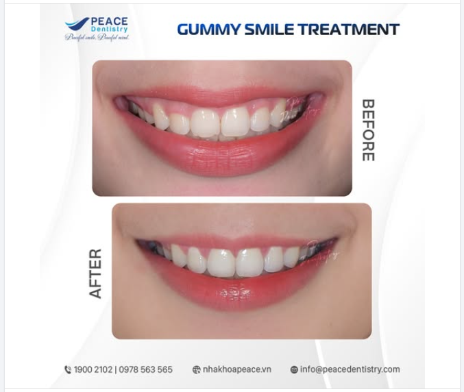 CẮT NƯỚU CẢI THIỆN HỞ LỢI – ĐIỀU CHỈNH NHỎ THAY ĐỔI LỚN CHO NỤ CƯỜI MÙA TẾT