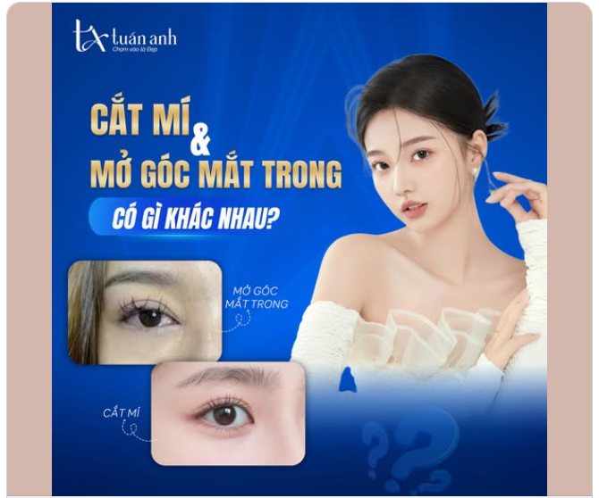 CẮT MÍ HAY MỞ GÓC MẮT: ĐÂU LÀ “CHÌA KHÓA” CHO ĐÔI MẮT ĐẸP?