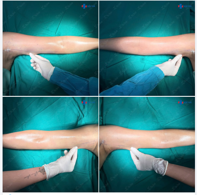 HÚT MỠ CÁNH TAY – GIẢM NGAY 40% TẶNG FREE HÚT MỠ VÙNG NÁCH