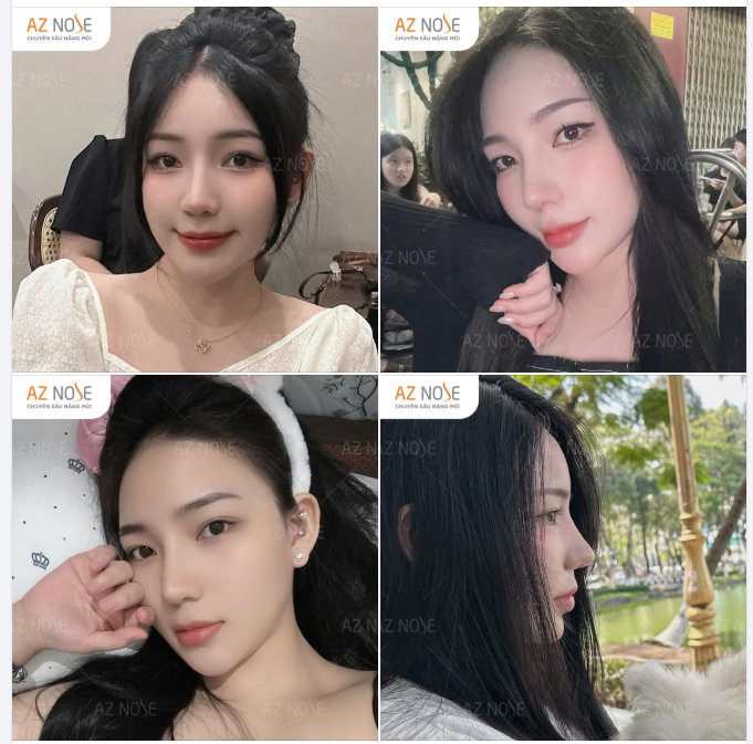 Feedback xinh yêu từ sinh viên năm 4 sau 2 năm nâng mũi