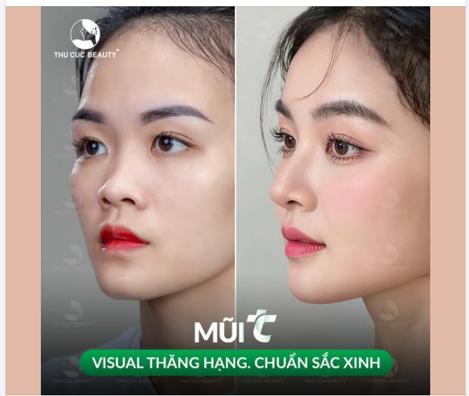 Biến hình xinh như "hot girl" với dáng mũi mới