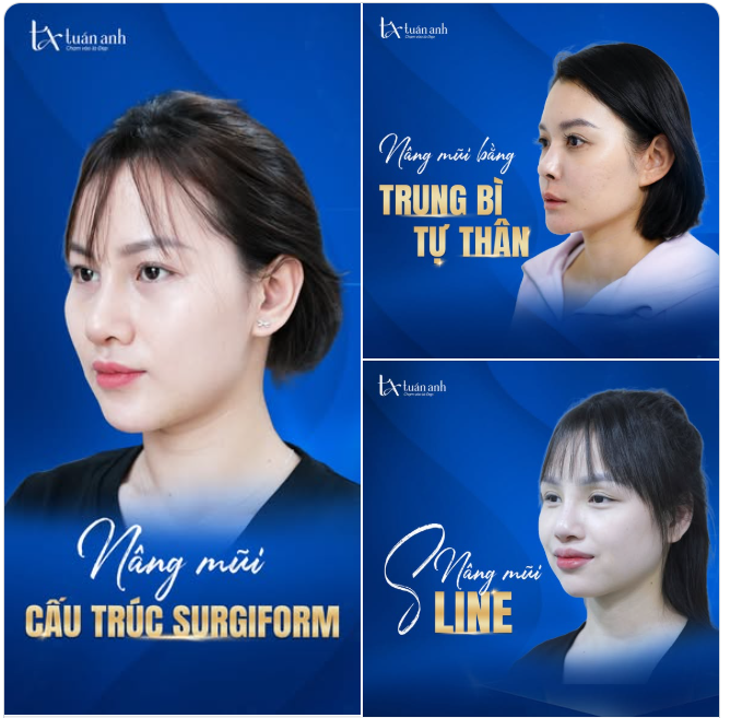 LỘ DIỆN TOP 3 DÁNG MŨI ĐƯỢC YÊU THÍCH NHẤT TẠI THẨM MỸ TUẤN ANH