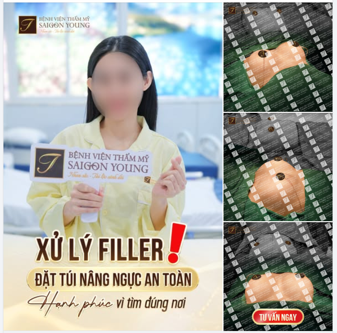 Filler không phải lối đi lâu dài cho vòng 1  Khách hàng tìm Bác sĩ Tươi xử lý an toàn và nâng ngực lại bằng túi