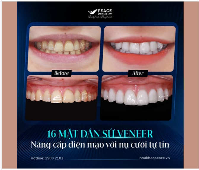 NỤ CƯỜI KHỎE ĐẸP VỚI VENEER - XU HƯỚNG CHƯA BAO GIỜ HẠ NHIỆT!!